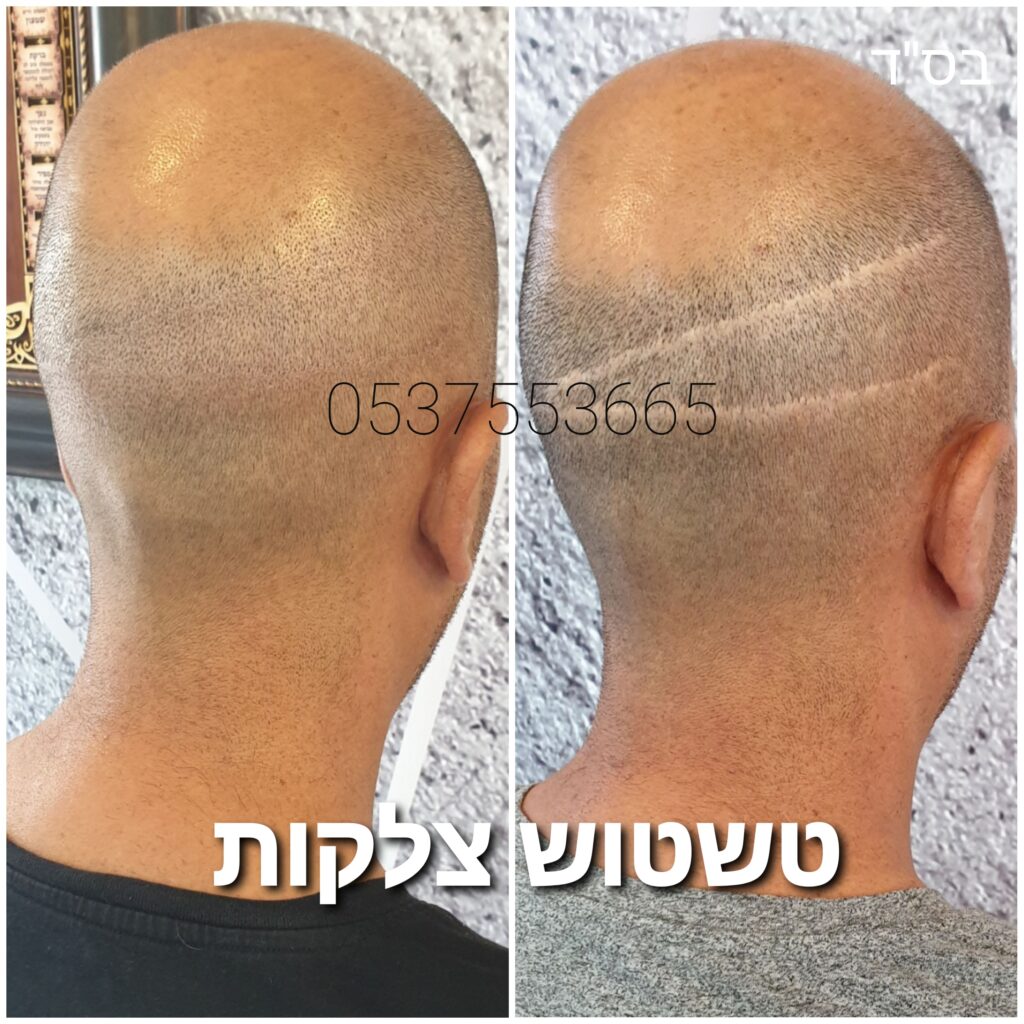 טשטוש קווי צלקות השתלת שיער בישראל