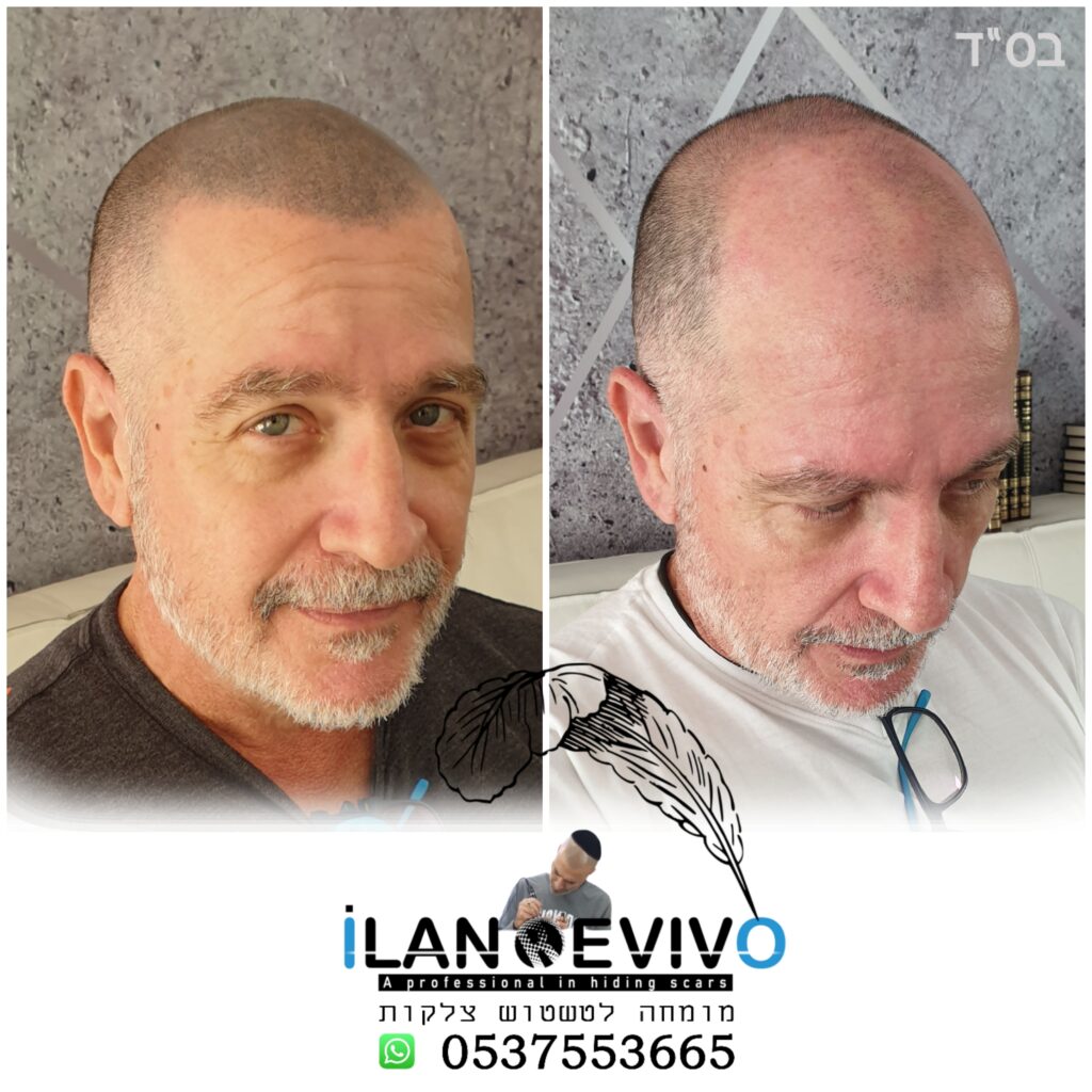 תמונות לפני ואחרי צפיפות הדמיית שיער