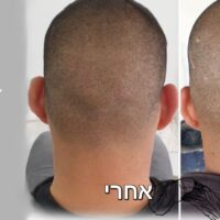 טשטוש צלקות: תיקון צלקות מהשתלה בהדמיית שיער