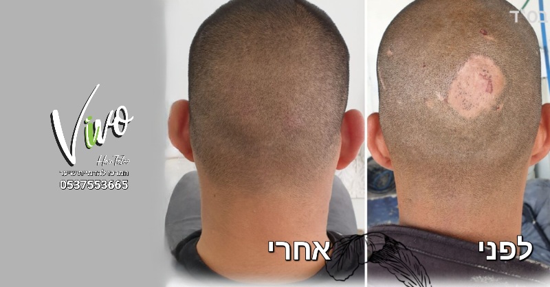 טשטוש צלקות: תיקון צלקות מהשתלה בהדמיית שיער
