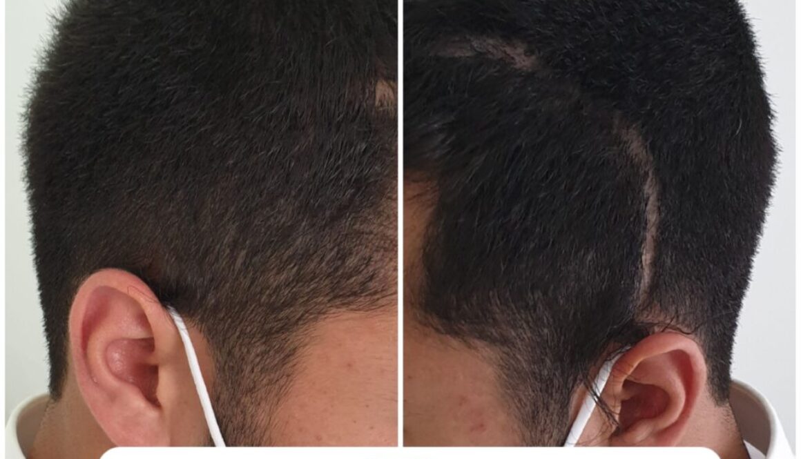 צלקות בשיער | תיקון מדויק 100% בעבודת יד מקורית Vivo – המרכז להדמיית שיער