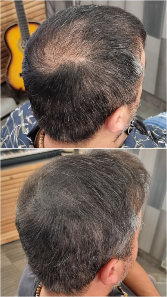 מילוי שיער אחרי השתלה