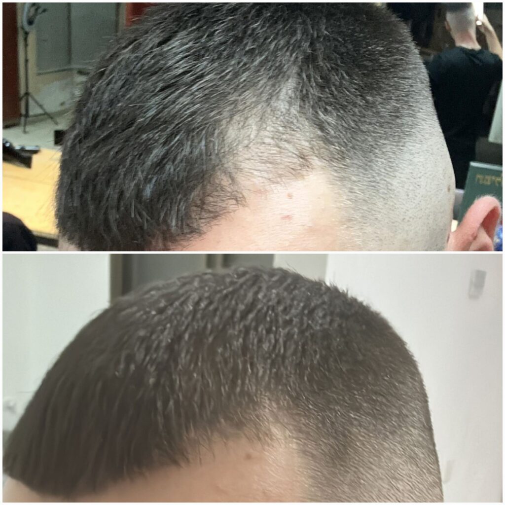 תמונות לפני ואחקי מילוי הדמיית שיער מיקרופיגמנטציה במפרצים לגבר עם שיער מלא
