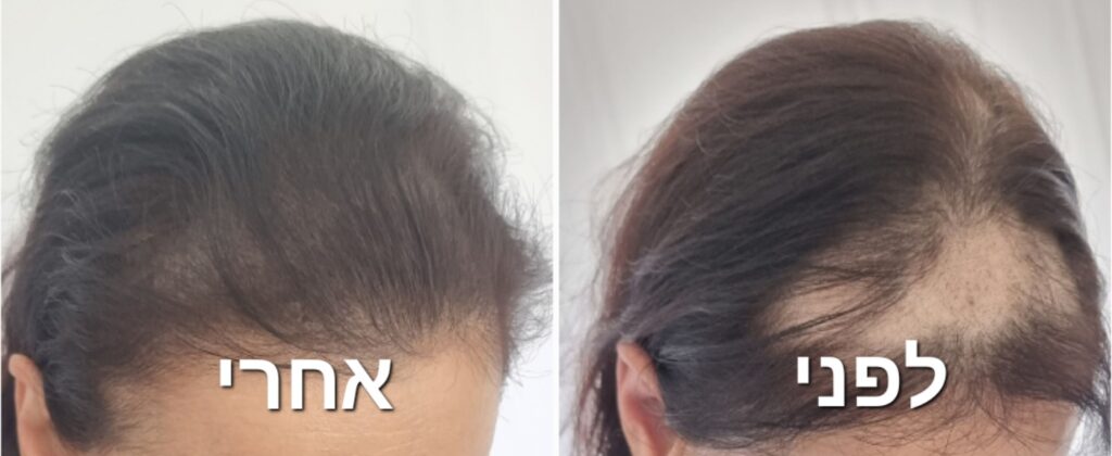 הדמיית שיער לנשים | פיגמנטציה למילוי שיער | מיקרופיגמנטציה לתלישת שיער טריכוטילומניה | תיקון קרחות בצביעת קרקפת